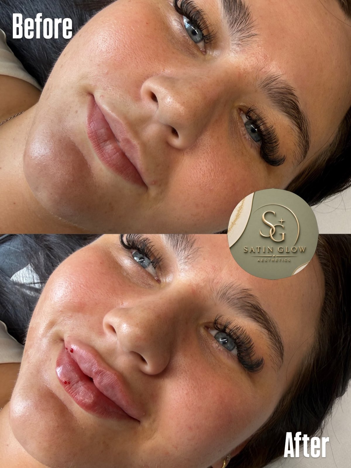 Lip filler before and after by Satin Glow Aesthetics