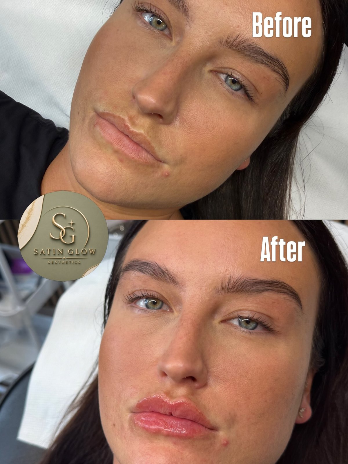 Lip filler before and after by Satin Glow Aesthetics